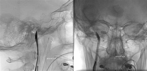 balloon occlusion testing